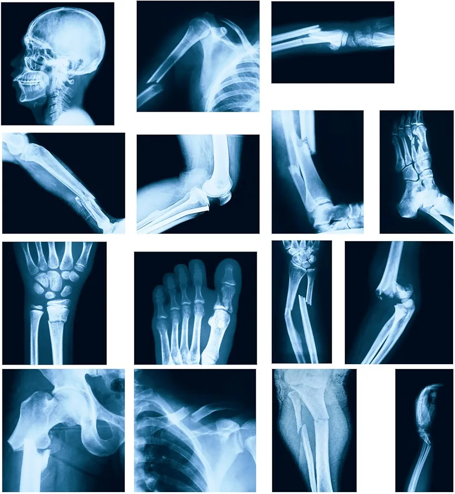 15 Pcs Broken Bones x Ray Set Human x Rays Black and Blue Skeleton Pretend Xrays for Kids